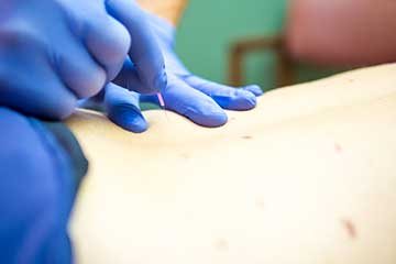 Trigger Point Dry Needling (TDN) Near Fort Collins in Loveland
